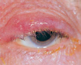 Blepharitis