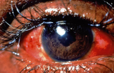 Eye Inflamation