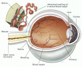 Retinopathy