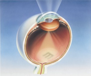 Cataract Eye