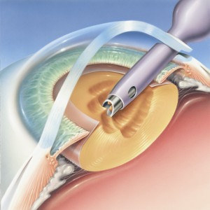 Cataract Removed
