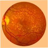 Macular Degeneration