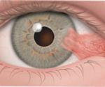 Pterygium