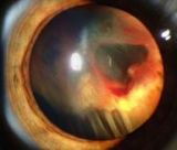 Retinal Detachment