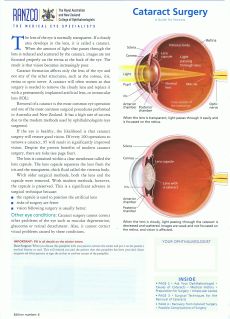 Cataracts